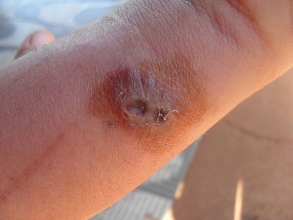 Lesion on arm of a human who worked as a milker, São Paulo State, Brazil. The lesion was determined to be caused by infection with vaccinia virus.
