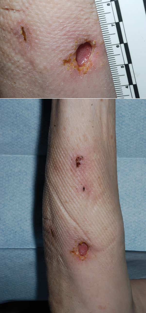 Forearm lesion after incision and drainage in immunosuppressed woman with cutaneous Legionella longbeachae infection, United Kingdom.