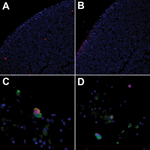 Thumbnail of WU polyomavirus antigen in respiratory epithelial cells from lungs transplanted into a recipient (28-year-old woman) with Job syndrome. Immunofluorescence of 293T cells transfected with pDEST26-WU–virus protein 1 and stained with A) WU virus protein 1 polyclonal antibody (NN-Ab01) or B) preimmune serum. C) Double immunofluorescence with NN-Ab01 (red) and a monoclonal antibody against cytokeratin (green) showing a double-positive cell from the bronchoalveolar lavage specimen. D) Bron