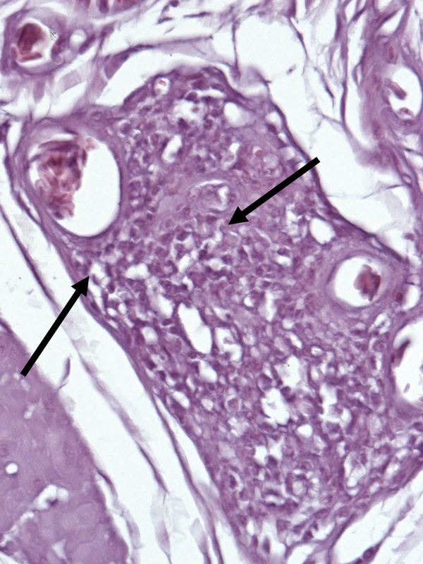 Section of the crop of a white-eyed conure (Aratinga leucophthalmus; bird no. 70 [Table 1]) from Brazil that was infected with avian bornavirus genotype 4. Stain shows mononuclear infiltration typical of proventricular dilatation disease (arrows). Hematoxylin and eosin stain; original magnification ×1,000.