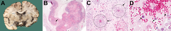 Postmortem pathologic findings for woman in the Netherlands who died of Balamuthia mandrillaris meningoencephalitis after returning from travel to The Gambia. A) Macroscopic coronal central section scan showing hemorrhagic necrotizing lesions of the subependymal, meningeal, and parenchymal areas of the parietotemporal lobes (circles and arrows). B) Low-power microscopic scan showing hemorrhagic necrotizing angiitis of the meningeal vessels (arrow) (original magnification ×25). C) Medium-power mi