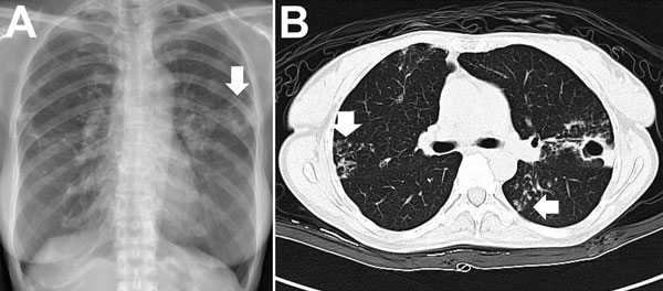 Chest radiograph (A) and computed tomography scan (B) images for a patient with pulmonary disease due to Mycobacterium abscessus subsp. abscessus. A) The arrow indicates a cavity with surrounding consolidation over the left upper lung. B) Vertical arrow indicates bronchiectasis; horizontal arrow indicates nodules.