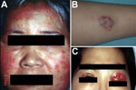 Thumbnail of Skin lesions caused by Mycobacterium abscessus subsp. abscessus. A) Diffuse erythematous papular eruptions on the face and bilateral cervical lymphadenitis in a middle-aged man. B) A circumscribed subcutaneous nodule with pus discharge on the right arm of a 12-year-old boy. C) Wound infection over both upper eyelids of a 36-year-old woman; the infection developed 1 week after cosmetic surgery.