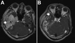 Thumbnail of Brain computed tomography scan images for a patient with central nervous system infection caused by Mycobacterium abscessus subsp. bolletii. Arrows indicate abnormal nodular pachymeningeal thickening and leptomeningeal and intraparenchymal extension with multiple rim-enhancing lesions in the right cerebellum (A) and right temporal lobe (B), indicating cerebral abscesses.