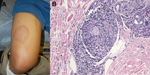 Thumbnail of Physical examination and histopathologic manifestations of leprosy in a 44-year-old man in California, USA (active member of the US military). A) Large, annular, cutaneous plaque on the thigh. B) Skin biopsy specimen showing perineural lymphohistiocytic inflammation and non-necrotizing granulomas (hematoxylin and eosin stained, original magnification ×40).