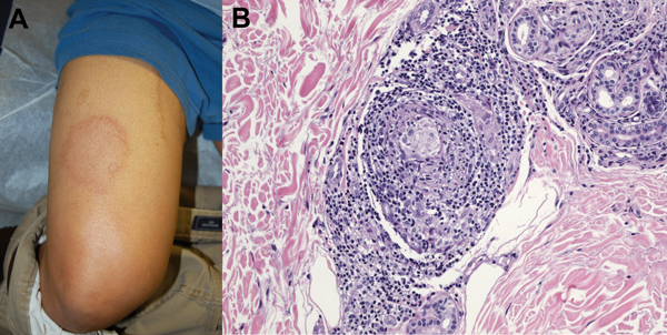 Physical examination and histopathologic manifestations of leprosy in a 44-year-old man in California, USA (active member of the US military). A) Large, annular, cutaneous plaque on the thigh. B) Skin biopsy specimen showing perineural lymphohistiocytic inflammation and non-necrotizing granulomas (hematoxylin and eosin stained, original magnification ×40).