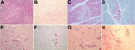 Thumbnail of Histopathologic and immunohistochemical (IHC) testing results for bean goose. A) Diffuse necrotizing pancreatitis (hematoxylin and eosin [H&amp;E] stain). B) Avian influenza virus antigen in necrotic pancreatic cells (IHC stain). C) Segmental necrosis of myofibers with mildly swollen nuclei focal necrosis (H&amp;E stain). D) Avian influenza virus antigen in necrotic myofiber of the heart (IHC stain). E) Paucity of Purkinje cells, cerebellum (H&amp;E stain). F) Avian influenza virus 