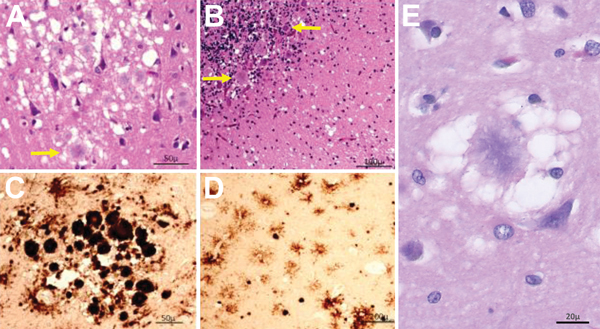 Results of histopathologic and immunohistochemical analyses for a US patient with variant Creutzfeldt-Jakob disease. A) Hematoxylin and eosin staining shows many typical florid plaques (A, arrow) occasionally forming clusters; large vacuole spongiform change is also present (A; original magnification ×10). B) Plaques often not of the florid type along with spongiform change are present in cerebellum (arrows; original magnification ×20). C, D) Prion protein immunostaining confirms the presence of