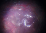 Thumbnail of Intraoperative fundus image depicting a migrating hookworm (Ancylostoma ceylanicum) ≈10 mm in length in the subretinal space of the eye of 10-year-old patient in Germany. 