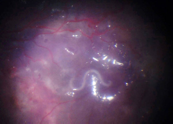 Intraoperative fundus image depicting a migrating hookworm (Ancylostoma ceylanicum) ≈10 mm in length in the subretinal space of the eye of 10-year-old patient in Germany. 