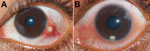 Thumbnail of Clinical photographs of patients’ eyes in study of ocular granulomas in children, South India. A) Left eye of a 14-year-old boy with a distinct subconjunctival granuloma; B) left eye of a 7-year-old boy with distinct grayish-white granuloma in the eye’s anterior chamber.
