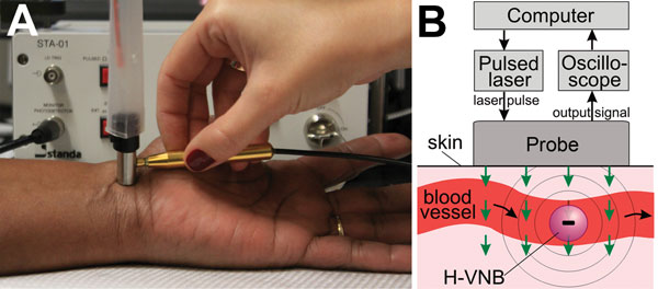 A) Experimental laboratory prototype of a malaria diagnostic device with the pulsed laser and the integrated probe shown being scanned across a human wrist. B) Functional diagram of the prototype and the principle of transdermal optical excitation and acoustic detection of vapor nanobubbles around hemozoin in malaria-infected cells exposed to the laser pulses (green arrows). H-VNB, hemozoin-generated vapor nanobubble.