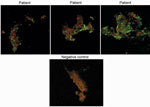 Thumbnail of Immunofluorescence assay results of samples from 3 Candidatus Coxiella massiliensis–infected patients and 1 noninfected person (negative control).