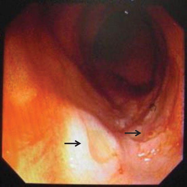 Multiple, shallow, oozing ulcers at the terminal ileum (arrows) detected by colonoscopy on day 4 of hospitalization for case-patient 1, who had a disseminated infection with Talaromyces marneffei.