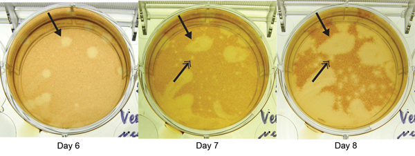 Plaque reduction neutralization test of patient sample for Heartland virus, showing images of the same well obtained days 6, 7, and 8 postinoculation at a dilution of 1:20. Arrows with single heads indicate appearance of a novel virus plaque beginning at day 6. Arrows with double heads indicate development of a typical Heartland virus plaque, apparent on day 7 and more evident on day 8, generated from a control strain added to each well in defined quantities to identify Heartland virus–specific 