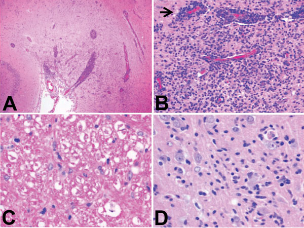 Histopathologic features of brain tissue from foxes with possible virus-induced neurologic disease. A) Multifocal, randomly distributed areas of severe encephalitis and meningitis in the cerebrum (original magnification ×40). B) Detail of encephalitis in the cerebrum (original magnification ×200). Gray and, to a lesser extent, white matter of the cerebrum showed randomly dispersed areas of astrocytosis, gliosis, and infiltration with lymphocytes and plasma cells. Blood vessels in affected areas 