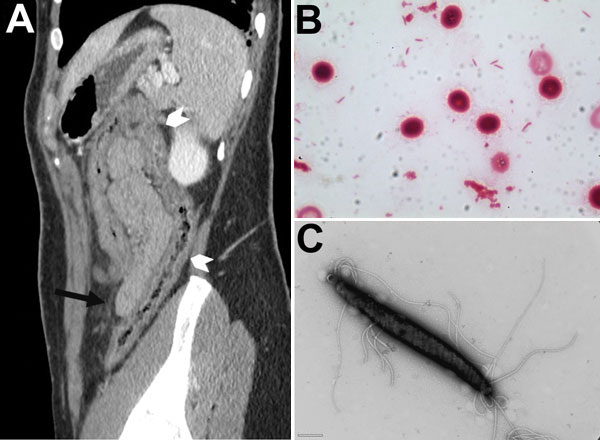 Computed tomographic image of patient with Helicobacter trogontum infection and micrographs of H. trogontum. A) Paramedian sagittal section of an abdominopelvic scan after injection of contrast medium in the portal phase, showing thickening of the transverse and right colon (white arrowheads) with tubular appearance and discrete thickening of the fat stranding (black arrow). B) Gram-stained blood culture smear. Original magnification ×1,000. C) Transmission electron micrograph of negatively stai