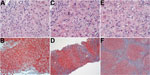 Thumbnail of Serial histologic changes in liver of the patient who received a diagnosis of hepatitis E after a visit to Hong Kong in 2013 (A and B: at first biopsy; C and D: second biopsy; E and F: third biopsy. A) Mild mixed portal infiltration; minimal lobular inflammation; acidophil body present at upper right; and bile duct showing injury with lymphocytic infiltration (original magnification ×400). b) Mild portal inflammation; some interface activity; and portal tracts not showing increased 