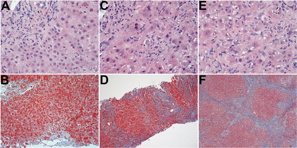 Serial histologic changes in liver of the patient who received a diagnosis of hepatitis E after a visit to Hong Kong in 2013 (A and B: at first biopsy; C and D: second biopsy; E and F: third biopsy. A) Mild mixed portal infiltration; minimal lobular inflammation; acidophil body present at upper right; and bile duct showing injury with lymphocytic infiltration (original magnification ×400). b) Mild portal inflammation; some interface activity; and portal tracts not showing increased fibrosity (or