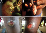 Thumbnail of Ulcers caused by infection with Haemophilus ducreyi. A, B) Genital ulcers in adult patients from Ghana (provided by David Mabey). C, D) Skin ulcers in children from Papua New Guinea (provided by Oriol Mitjà).