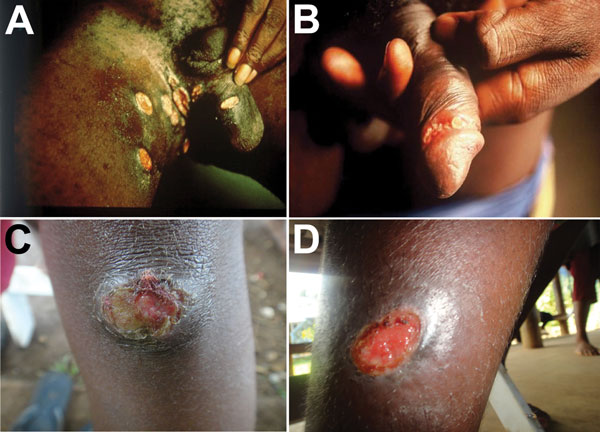 Ulcers caused by infection with Haemophilus ducreyi. A, B) Genital ulcers in adult patients from Ghana (provided by David Mabey). C, D) Skin ulcers in children from Papua New Guinea (provided by Oriol Mitjà).