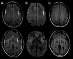 Thumbnail of MRI findings from a 47-year-old man with encephalitis-associated human metapneumovirus pneumonia, Australia. A) Axial MRI FLAIR at presentation. Arrows indicate multiple areas of bilateral subcortical and external capsule FLAIR hyperintensities and perirolandic predominance (top image). B) Axial MRI DWI at presentation. Arrows indicate corresponding increase in DWI signal in the affected areas. C) Axial FLAIR MRI after 3 months. The MRI changes have all resolved. DWI, diffusion weig