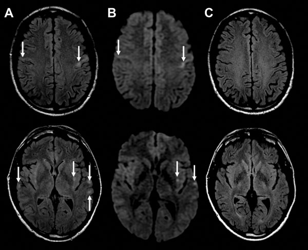 MRI findings from a 47-year-old man with encephalitis-associated human metapneumovirus pneumonia, Australia. A) Axial MRI FLAIR at presentation. Arrows indicate multiple areas of bilateral subcortical and external capsule FLAIR hyperintensities and perirolandic predominance (top image). B) Axial MRI DWI at presentation. Arrows indicate corresponding increase in DWI signal in the affected areas. C) Axial FLAIR MRI after 3 months. The MRI changes have all resolved. DWI, diffusion weighted imaging;