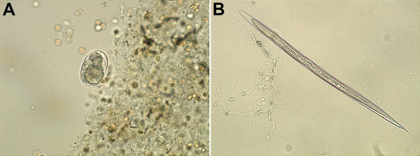 Ancylostoma ceylanicum hookworm isolated from a French tourist returning from Myanmar. A) Ova and blood cells in fecal specimen. B) Filariform larvae after stool culture. Original magnifications ×40.