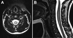 Thumbnail of Magnetic resonance imaging of 6-year-old girl with flaccid paralysis and enterovirus C105 infection, Virginia, USA, October 2014. A) Axial T2-weighted image of the cervical spine demonstrating abnormal hyperintensity of the central gray matter (right to left). B) Sagittal T2-weighted image of the cervical spinal cord demonstrating faint longitudinally extensive central hyperintensity and associated cord edema.