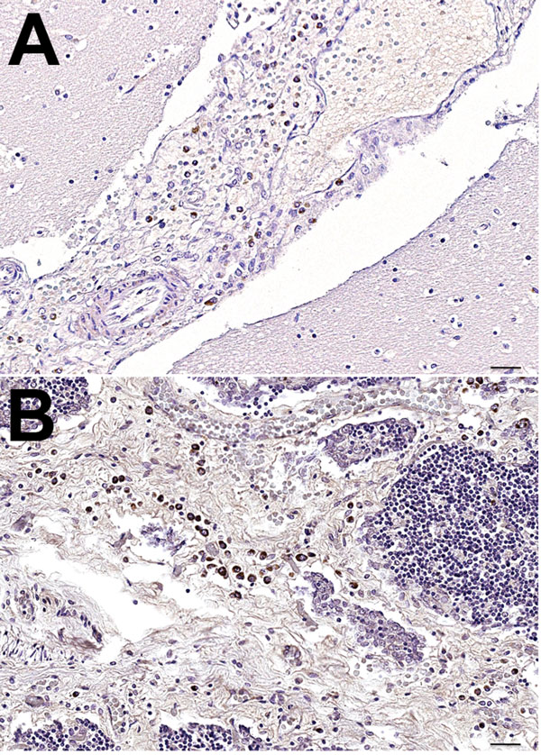 Mayer hematoxylin counterstained tissue samples from a newborn fin whale stranded off the Mediterranean Sea, October 2013. A) Brain tissue showing positive immunostaining for morbillivirus. antigen in macrophages in the meningeal space. B) Fin whale thymus showing positive immunostaining for morbillivirus antigen in thymocytes and macrophages. For both samples, morbillivirus was detected by immunohistochemical analysis, using a rabbit hyperimmune anti–rinderpest virus serum (provided by Pirbrigh
