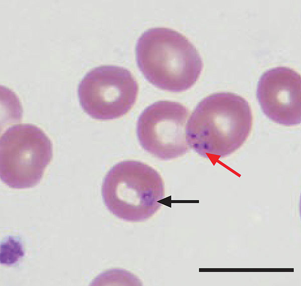 Wright-stained peripheral blood smear from patient A (index case-patient), a renal transplant recipient infected with Babesia microti parasites, Wisconsin, USA, 2008. The smear shows intraerythrocytic Babesia parasites, a ring form (black arrow), and a Maltese cross or tetrad form (red arrow), which is pathognomonic for babesiosis. Scale bar indicates 10 μm.