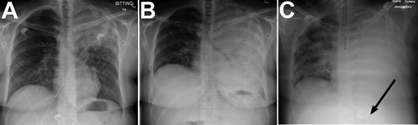 Chest radiograph at various stages of Blastomyces gilchristii infection in a 27-year-old woman, Ontario, Canada. A) Day 0: posterior–anterior (PA) chest radiograph at initial emergency department examination. Discrete confluent left upper lobe consolidation with air bronchograms are visible. B) Day 5, 15:10: PA chest radiograph demonstrating complete confluent opacification of the left hemithorax with extensive air bronchograms. C) Day 6, 23:30: PA chest radiograph postintubation with confluent 