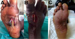 Thumbnail of A) Foot of a 47-year-old man showing wound infected with Sporolactobacillus laevolaticus, Marseille, France. B) Drainage of a cellulitis abscess. C) Extent to which the wound on the arch of the foot had healed 6 weeks after surgery and antimicrobial drug therapy. A color version of this figure is available online (http://wwwnc.cdc.gov/EID/article/21/11/15-1197-F1.htm). 
