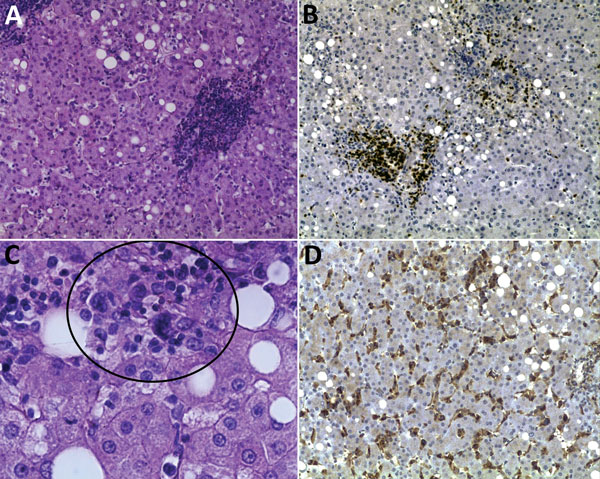 Histopathologic appearance of liver biopsy sample from woman with fatal human monocytic ehrlichiosis, Mexico, 2013. A) Clusters of cells in the liver lobule. Hematoxylin and eosin (H&amp;E) stain; original magnification ×200. B) Immunohistochemical detection of T lymphocytes (CD3). Original magnification ×100. C) Multinucleated cells in parenchyma (circle). H&amp;E stain; original magnification ×400. D) Immunohistochemical detection of macrophages and hyperplasia of Kupffer cells (CD68). Origina