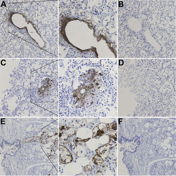 Immunohistochemical detection of WU polyomavirus viral protein 1 in respiratory tract of a child with fatal acute respiratory illness. Human lung tissue at original magnification of ×200, stained with a monoclonal antibody against WU polyomavirus viral protein 1 (designated NN-Ab06) (A, C) or an isotype control antibody (B, D). Human tracheal tissue at original magnification of ×200, stained with NN-Ab06 (E) or an isotype control antibody (F). The middle panels show insets from panels A, C, and 