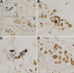 Thumbnail of Detection of WU polyomavirus viral protein 1 in CD68-positive cells from a child with fatal acute respiratory illness. Lung tissue stained with NN-Ab06 (blue) and a monoclonal antibody against CD68 (brown). A) Tissue at original magnification of ×400. B) Closer view of cell from panel A consistent with a foamy macrophage (arrow). Original magnification ×1,000. C) Closer view of cells from panel A. Original magnification ×1,000. D) Different field of the tissue section with another d