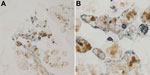 Thumbnail of Detection of WU polyomavirus viral protein 1 in close proximity to MUC5AC-positive cells in the trachea of a child with fatal acute respiratory illness. Tracheal tissue stained with NN-Ab06 (blue) and a monoclonal antibody against MUC5AC (brown). A) Tissue at original magnification of ×200. B) Tissue at original magnification of ×600.