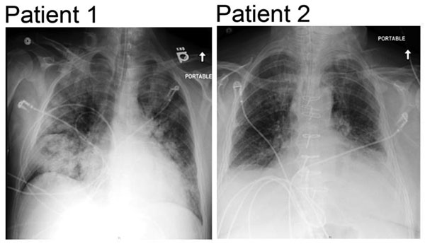 Admission chest radiographs of 2 adults with severe infections with adenovirus type 7 in family, Illinois, USA, 2014. Chest radiograph of patient 1 shows diffuse parenchymal consolidation involving all lobes. Chest radiograph of patient 2 shows interstitial changes in all lung fields and cardiomegaly.