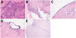 Thumbnail of Central nervous system pathology in mice that had signs of neurologic involvement and succumbed to infection with bimBm and bimBp Burkholderia pseudomallei isolates. Evidence of central nervous system pathology was demonstrated in these mice. Inflammatory infiltrates were prominent in trigeminal nerve branches and ganglion (original magnification ×400) (A) and in the olfactory bulb (original magnification ×200) (B). Cranial meningitis (C) and spinal (D) meningitis were observed, oft
