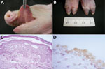 Thumbnail of Pathologic alterations in piglets infected with Senecavirus A, Brazil, 2015. Gross examination shows multifocal diphtheric glossitis (A) and ulcerations of the coronary band (B). Histopathologic images demonstrate ballooning degeneration of the epithelium of the tongue (C) and positive immunoreactivity of the uroepithelium of the urinary bladder (D) to Senecavirus A. Panel B, scale shown in centimeters; panel C, hematoxylin and eosin stain, scale bar indicates 20 μm; panel D, immuno