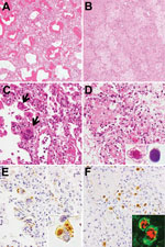 Thumbnail of Histologic findings from postmortem lung tissues of children who died from measles-associated pneumonia in a pediatric intensive care unit, National Hospital of Pediatrics, Hanoi, Vietnam, January–October 2014. A) Diffuse alveolar damage with hyaline membrane formation (hematoxylin and eosin [H&amp;E] stain, original magnification ×100). B) Necrotizing pneumonia with coagulation necrosis (H&amp;E stain, original magnification ×100). C) Measles giant cell pneumonia. Arrows indicate s