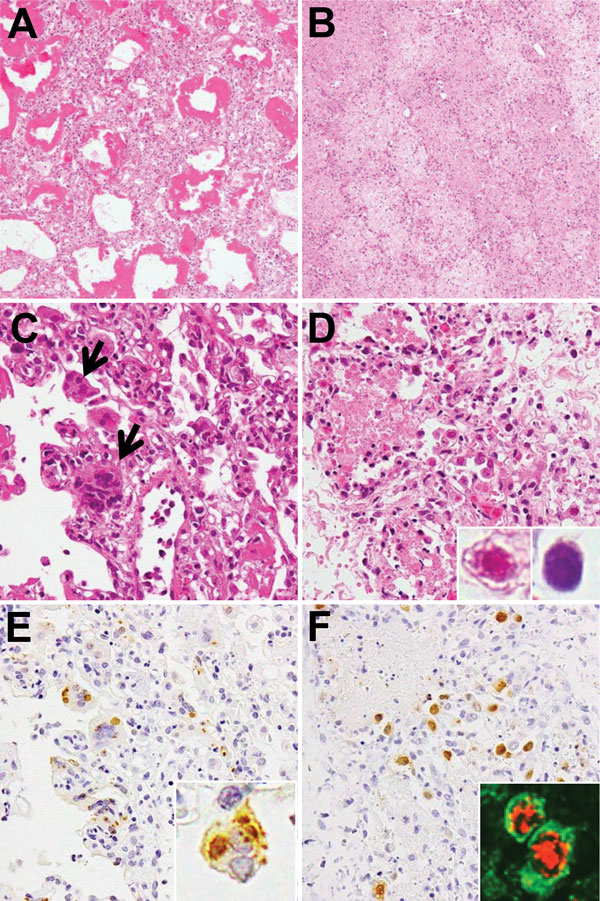 Histologic findings from postmortem lung tissues of children who died from measles-associated pneumonia in a pediatric intensive care unit, National Hospital of Pediatrics, Hanoi, Vietnam, January–October 2014. A) Diffuse alveolar damage with hyaline membrane formation (hematoxylin and eosin [H&amp;E] stain, original magnification ×100). B) Necrotizing pneumonia with coagulation necrosis (H&amp;E stain, original magnification ×100). C) Measles giant cell pneumonia. Arrows indicate syncytial cell