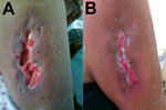 Thumbnail of A) Untreated community-associated methicillin-resistant Staphylococcus aureus ulcer on the right arm of a 58-year old woman from a rural area of the Amazon Basin, Peru. B) The same ulcer after 19 days of treatment with vancomycin and trimethoprim/sulfamethoxazole. 
