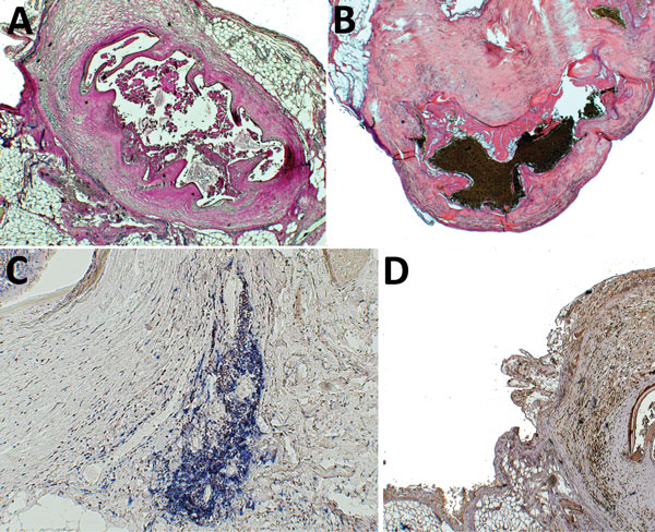 Histologic and immunohistochemical analyses of resected pentastomid lesions from patients in Sankuru District, Democratic Republic of the Congo, 2014–2015. A) Typical necrotic pentastomid lesion from patient 5. Internal structures of the larvae are decayed; only the directly surrounding exuvia following the annulated body of the parasite and the fibrous capsule are visible. This organism has been moleculary identified as A. armillatus. Periodic acid Schiff stain; original magnification ×2.5. B) 