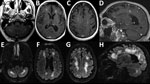 Thumbnail of Magnetic resonance imaging scans showing brain abnormalities in a previously healthy adult with Baylisascaris meningoencephalitis, California, USA. A–D) Postgadolinium contrast T1 images obtained 4 weeks after symptom onset. A–C) Axial images, moving inferiorly to superiorly, demonstrating nodular bilateral enhancement within the cerebellar hemispheres, thalami, and subcortical white matter. D) Sagittal image further demonstrates multifocal areas of enhancement in cerebral hemispher