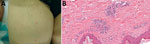Thumbnail of Rash and skin biopsy of a 60-year-old female traveler who had returned to Japan from India, January 2011. A) Rash on the inner side of the right thigh. B) Skin biopsy showing infiltration of inflammatory cells (mainly lymphocytes) around the capillaries, associated with hemorrhagic changes (hematoxylin-eosin staining, original magnification ×400).
