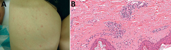 Rash and skin biopsy of a 60-year-old female traveler who had returned to Japan from India, January 2011. A) Rash on the inner side of the right thigh. B) Skin biopsy showing infiltration of inflammatory cells (mainly lymphocytes) around the capillaries, associated with hemorrhagic changes (hematoxylin-eosin staining, original magnification ×400).