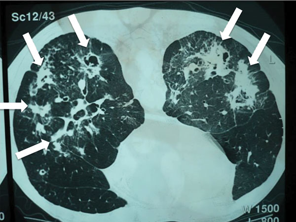Computed tomography radiograph of thorax showing chronic pulmonary histoplasmosis with bilateral cavitary infiltrates resembling pulmonary tuberculosis, coccidioidomycosis, paracoccidioidomycosis, and aspergillosis. Arrows indicate areas of abnormality. Image used with permission of Arnaldo Colombo (©2016, all rights reserved).