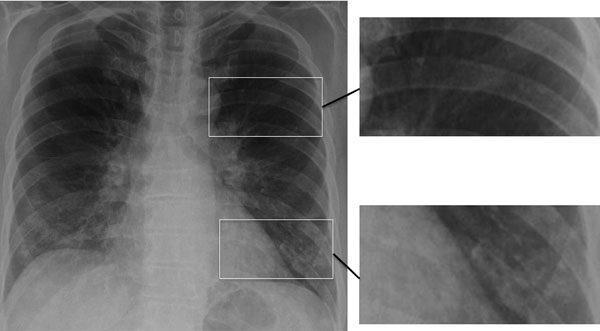 Chest radiograph showing early, subtle Pneumocystis pneumonia–associated abnormalities in both lower lungs of a patient newly diagnosed with AIDS; this diagnosis was unsuspected in the patient, a 63-year-old married man. Magnified images on right show normal lung (top image) and infiltrates adjacent to and behind the heart and overlain by rib (bottom image). Similar differences between the upper and lower lobes are seen in the radiograph on the left. Image used with permission of David Denning (