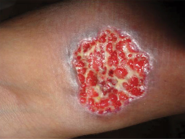 An ulcerative skin lesion that was positive for Cryptococcus neoformans fungus on biopsy. For several weeks before being correctly diagnosed, the lesion was misdiagnosed as a bacterial infection. Image used with permission of Arnaldo Colombo (©2016, all rights reserved).